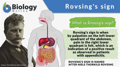 Rovsings sign - The sign described by Niels Rovsing in 1907 remains. relevant in today's practice. Although the absence of Rovsing's sign does. not exclude appendicitis, its presence helps to confirm the clinical. diagnosis. It is not something that patients volunteer spontaneously, but. when asked where the discomfort of left iliac fossa palpation is …